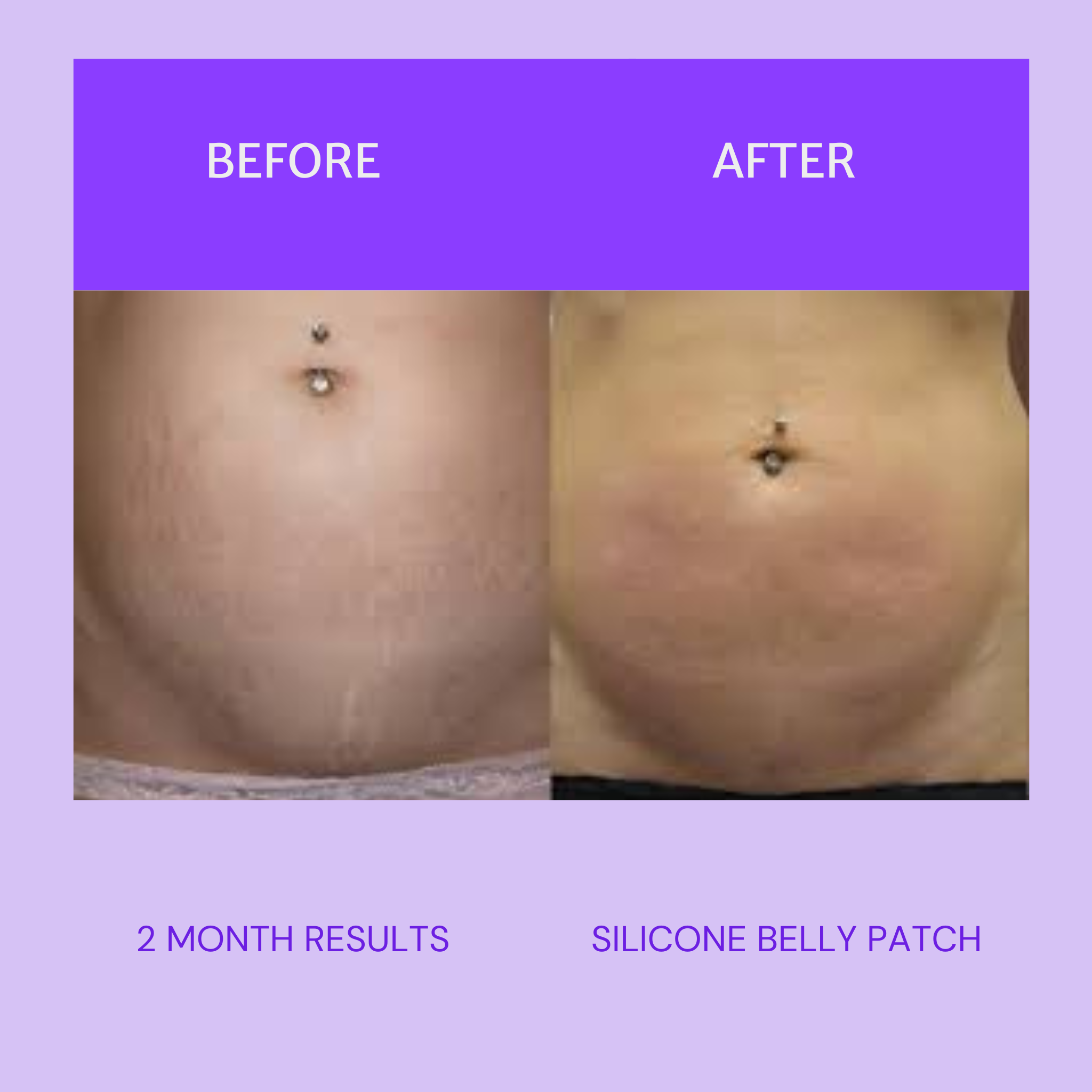 Silicone Belly Patch - Reusable 22 Times