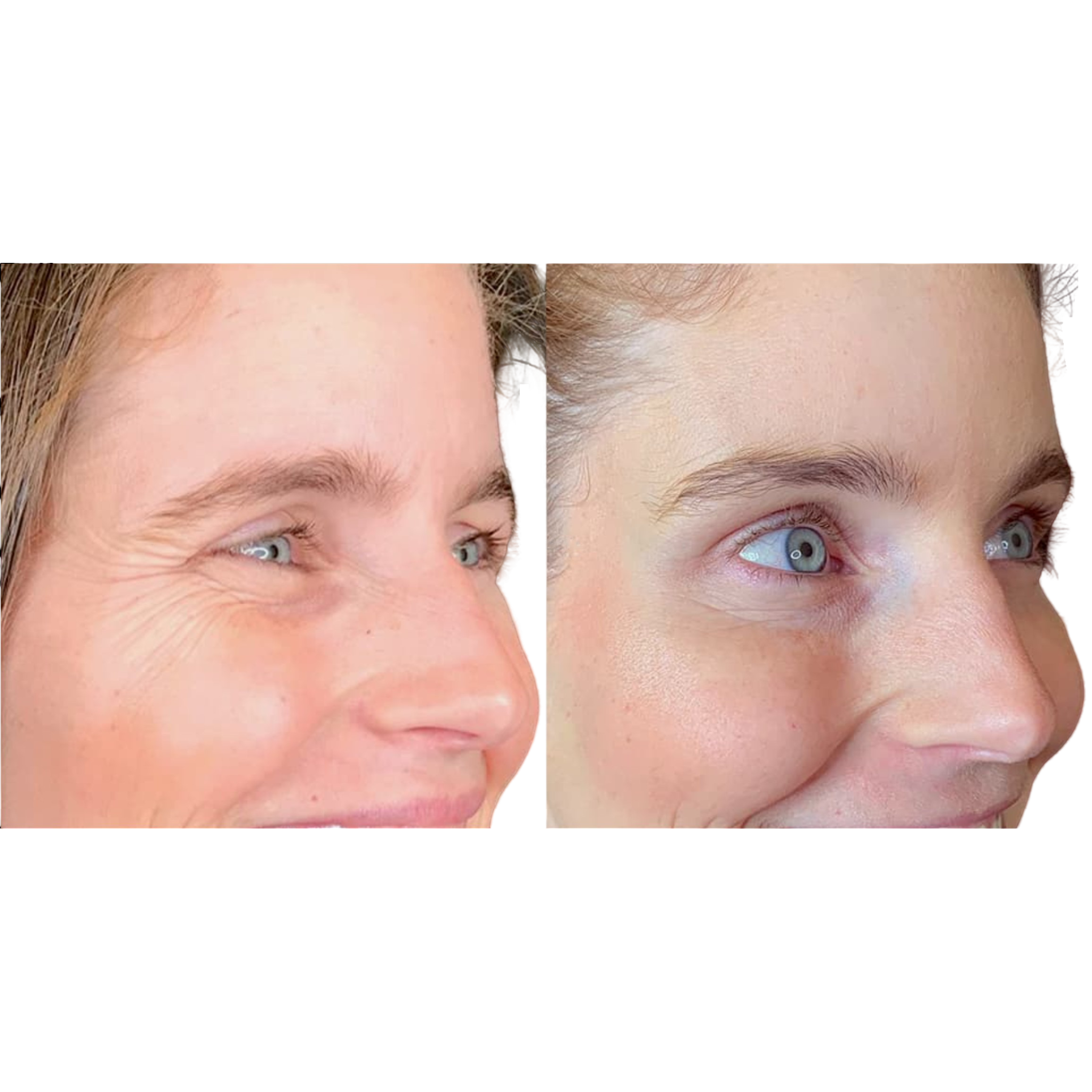Full Face Silicone Patch Kit