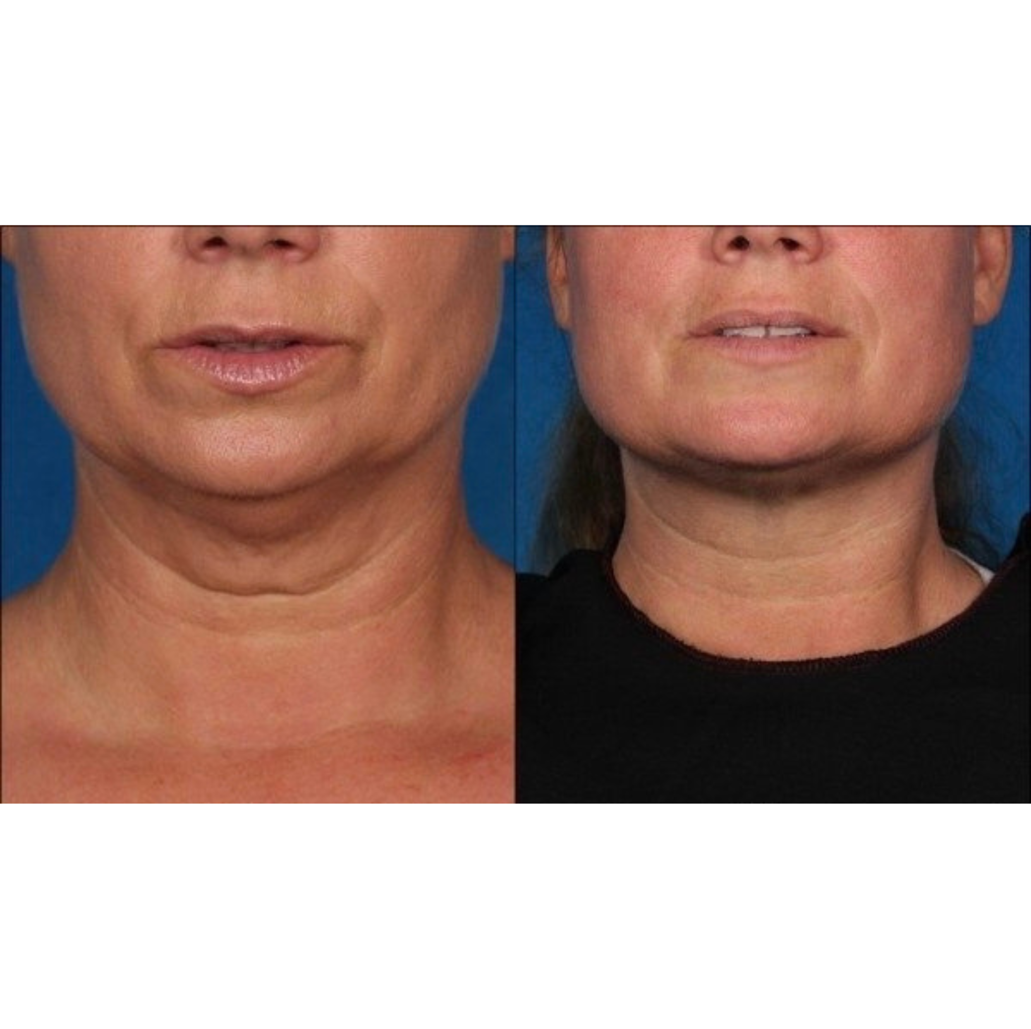 Silicone Neck Patch - Reusable 22 Times